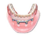 Dental Implants - Kitchener Dentist -Implant bar supported denture