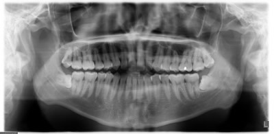 Digital Dental X-Rays - Kitchener Waterloo Dentist - Dental Radiograph