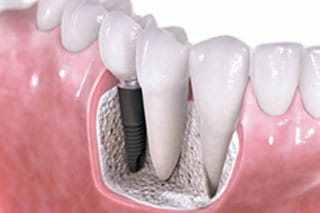 Dental Implants in Kitchener- Waterloo, ON
