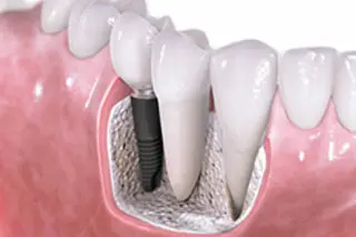 Dental Implants in Kitchener- Waterloo, ON