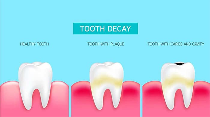 Family Dentistry | Plaque Development | Westgage Dental