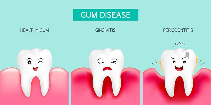 Family Dentistry | Gum Disease | Gingivitis | Westgage Dental