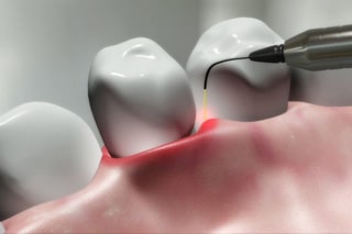 Gum Disease Therapy in Kitchener-Waterloo, ON