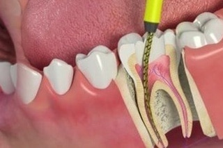 Root Canal Therapy in Kitchener-Waterloo, ON