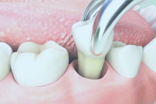 Wisdom Teeth Extraction in Kitchener-Waterloo, ON