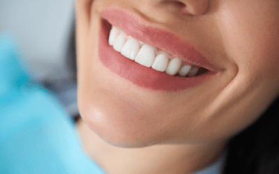 What Is Composite Bonding midtown dental smiles