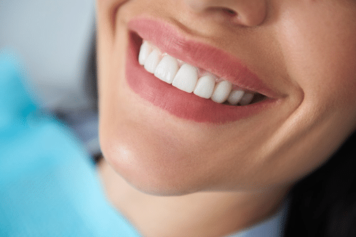 What Is Composite Bonding midtown dental smiles