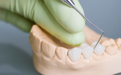 6 Benefits Of Dental Bridges