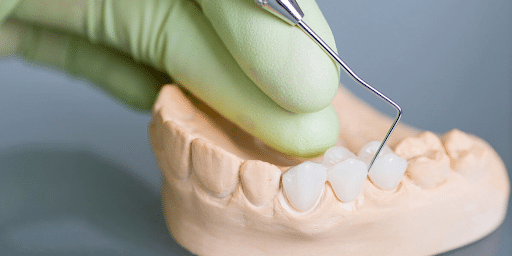 6 Benefits Of Dental Bridges