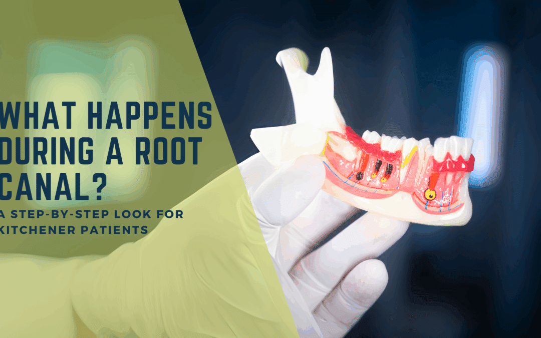 What Happens During a Root Canal? A Step-by-Step Look for Kitchener Dental Patients